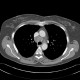 Castleman's disease: CT - Computed tomography
